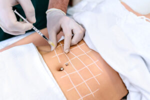 What to Expect After Fat Dissolving Injections?