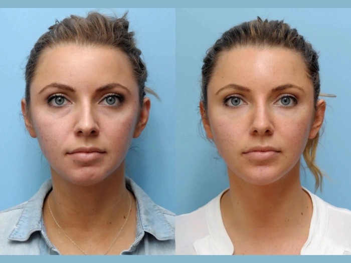 Why the Best Aesthetic Clinics in Dubai Are Top Choice for Thread Lift