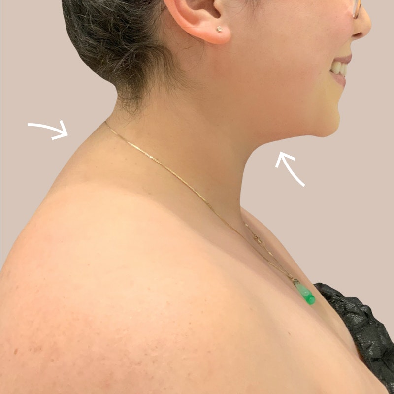 Buffalo Hump Removal in Dubai