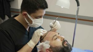 Hair Transplant in Dubai