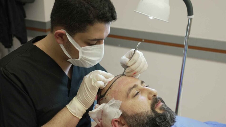 Hair Transplant in Dubai