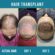 Hair Transplant