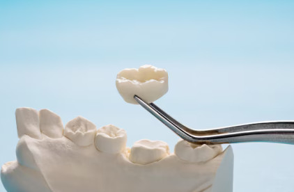 dental crowns tampa