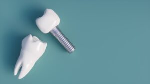 Dental Implants in the UK