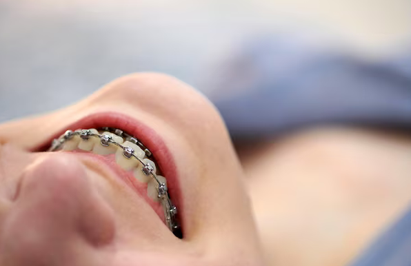 metal orthodontic braces san antonio