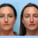 Meet the Best Plastic Surgeon in Dubai for Thread Lift Excellence
