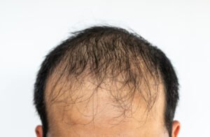Crown Hair Transplant to Restore Youthful Hair
