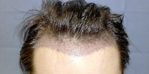 Does DHI Hair Transplant Work for Baldness