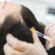 Does Stem Cell Therapy for Hair Loss Really Work