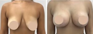 breast reduction in dubai