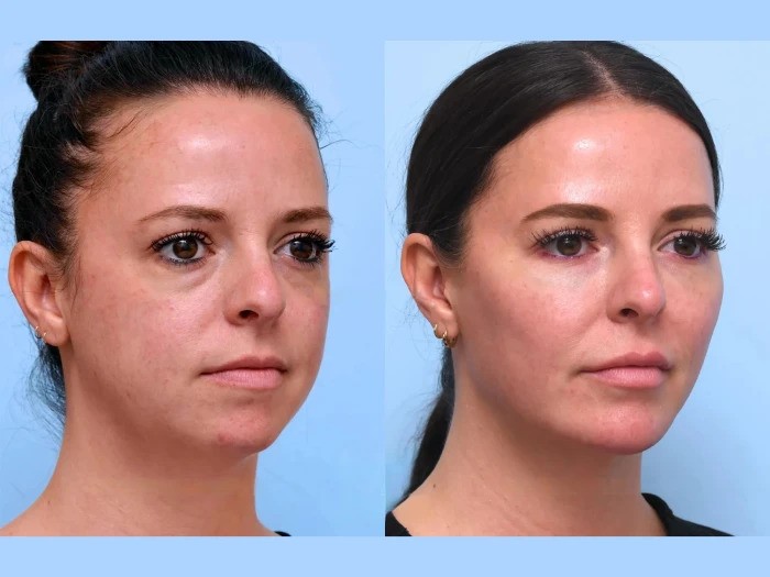 Discover Best Aesthetic Clinic in Dubai for a Natural Looking Thread Lift Today
