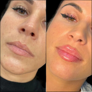 fillers in Dubai