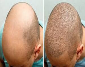 زراعة الشعر في الرياض