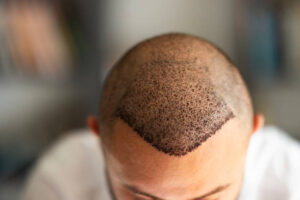 How Do Hair Transplants Compare to Natural Hair Growth