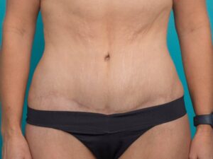Tummy Tuck Dubai