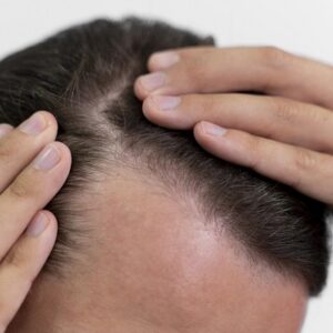 How Front Line Hair Fixing Restores Natural Looks