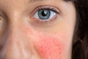 How Quick Are the Results of Rosacea Treatment