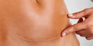 How Surgical Scar Revision Delivers Visible Results