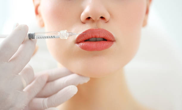 How to Prepare for Russian Lip Fillers