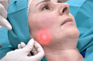 Is EndoLift a Good Choice for Skin Tightening?