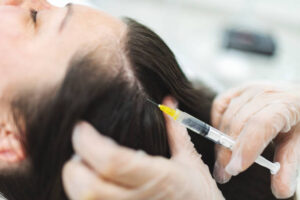 Is GFC Hair Treatment Effective for Early Hair Loss