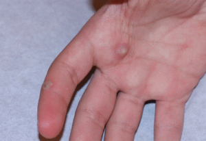 Is Warts Removal Treatment the Best Option?