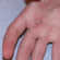 Is Warts Removal Treatment the Best Option?