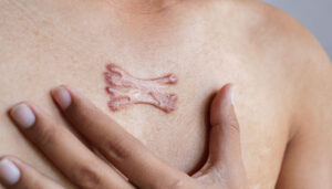 Keloid Treatment in Islamabad