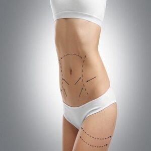 Liposuction Surgery in Dubai