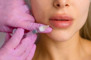 Non-Surgical Lip Enhancement with Fillers