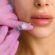 Non-Surgical Lip Enhancement with Fillers