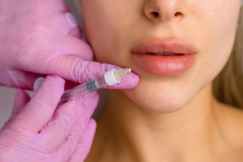 Non-Surgical Lip Enhancement with Fillers