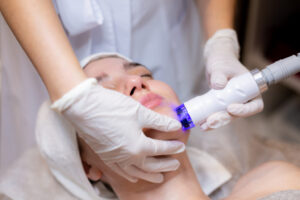 Professional Laser Treatments for Acne Scars