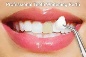 Professional Teeth Whitening Perth