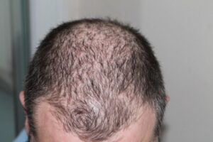 Restore Hair and Confidence with FUE Hair Transplant