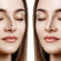 Rhinoplasty Surgery in Dubai
