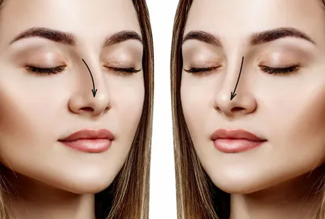 Rhinoplasty Surgery in Dubai