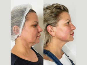 Endolift Treatments in Dubai: Safe and Effective Skin Rejuvenation