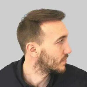 Sideburn Hair Transplant
