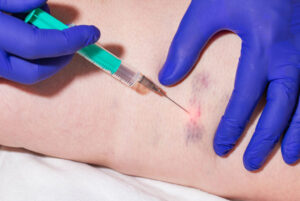 Treat Varicose Veins Professionally