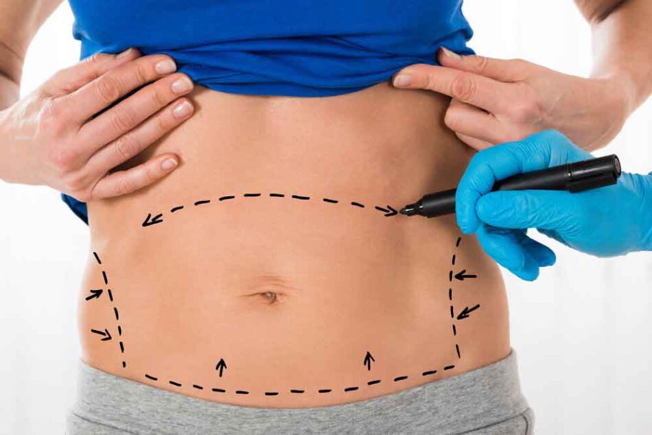 Liposuction Dubai