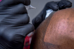 What Is Scalp Micropigmentation and Its Benefits