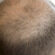 What Is the Crown Hair Transplant Process