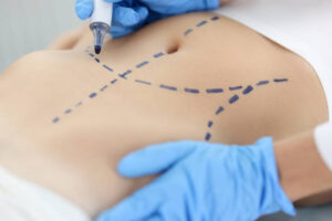 What is Liposuction and How Does it Work