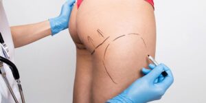 Brazilian Butt Lift in Dubai