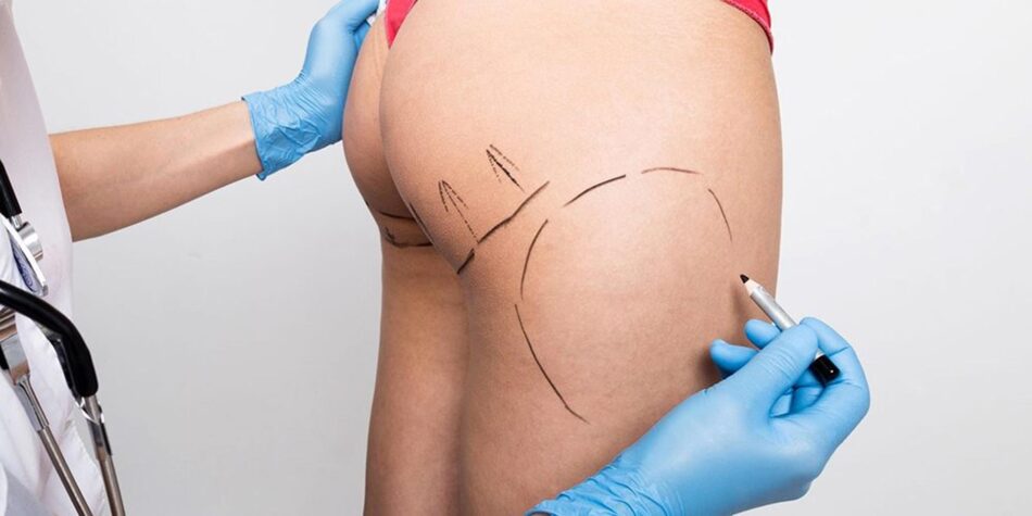 Brazilian Butt Lift in Dubai