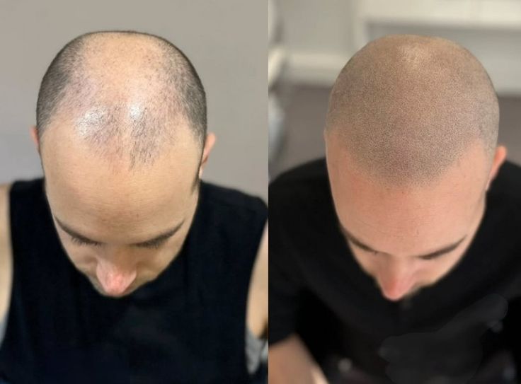 hair transplant in islamabad