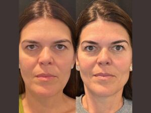 Best Aesthetic Clinics in Dubai Offer Reliable Thread Lift Treatments for Natural Youthful Facial Rejuvenation