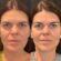 Best Aesthetic Clinics in Dubai Offer Reliable Thread Lift Treatments for Natural Youthful Facial Rejuvenation