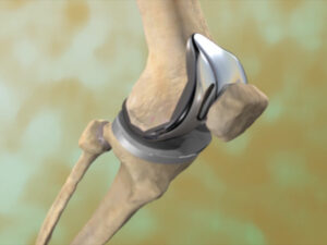 Knee Replacement in Jaipur